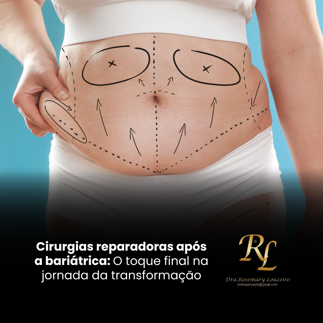 Você está visualizando atualmente Cirurgias reparadoras após a bariátrica: O toque final na jornada da transformação