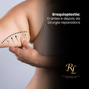 Leia mais sobre o artigo Braquioplastia: O antes e depois da cirurgia reparadora